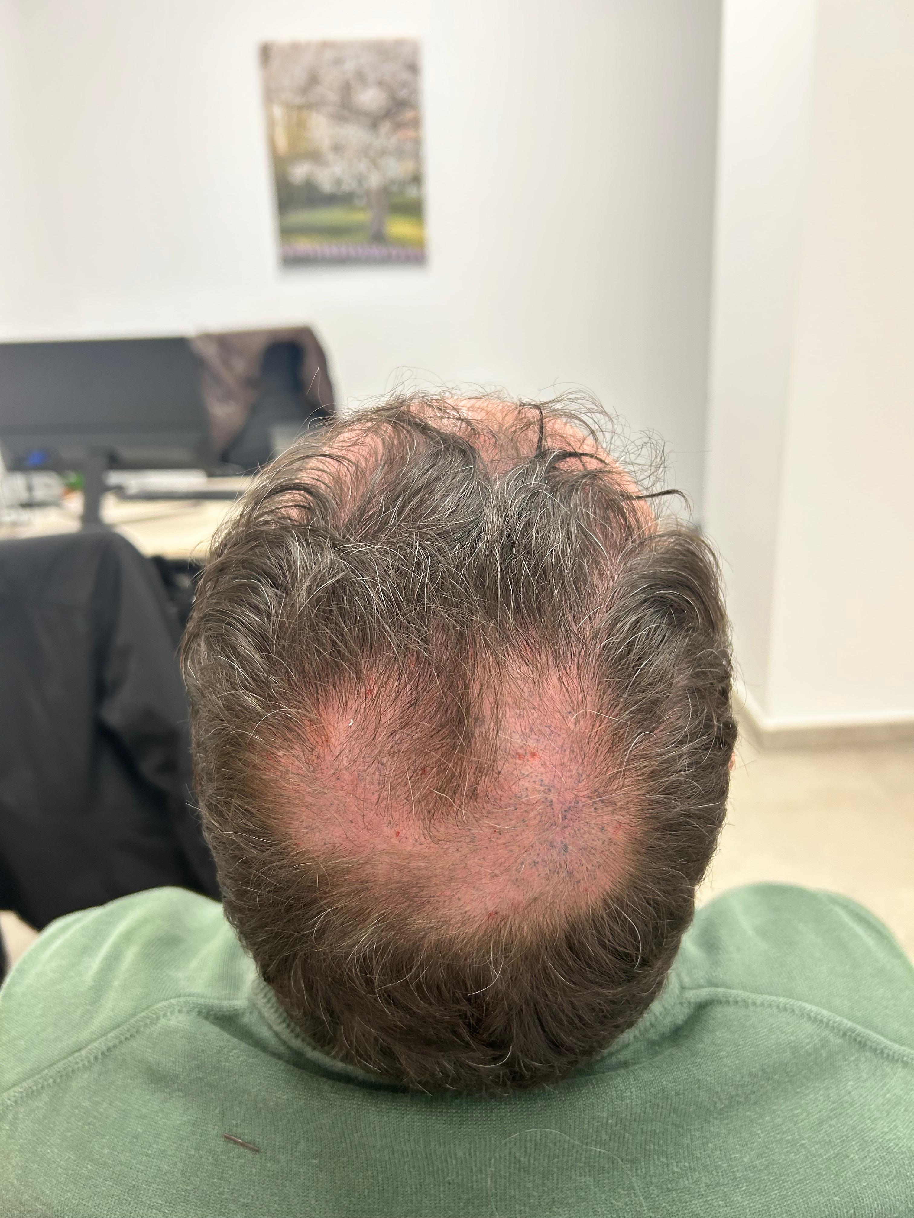 Antes del tratamiento · Caso 3